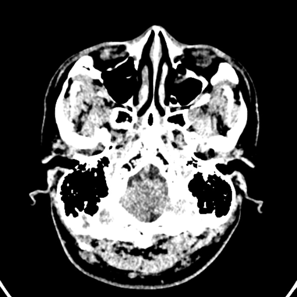 File:Cerebral arteriovenous malformation (Radiopaedia 37182-39012 Axial non-contrast 5).jpg