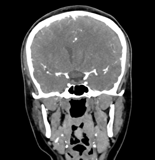 File:Cerebral arteriovenous malformation (Radiopaedia 73830-84645 C 43).jpg