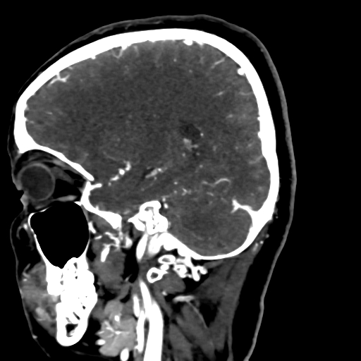 Cerebral arteriovenous malformation (Radiopaedia 73830-84645 Sagittal C+ delayed 31).jpg