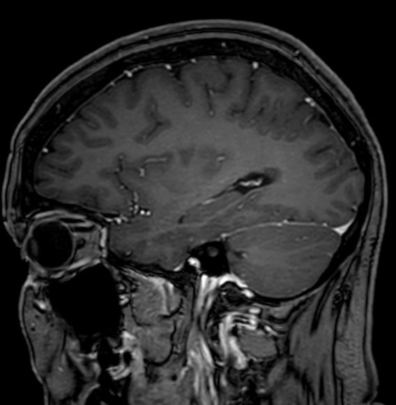 Cerebral arteriovenous malformation (Radiopaedia 74411-85746 Sagittal T1 C+ 35).jpg
