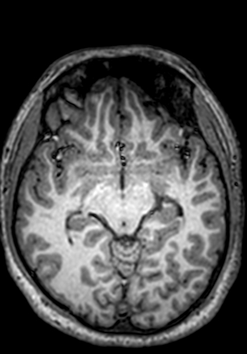 Cerebral arteriovenous malformation at posterior body of corpus callosum (Radiopaedia 74111-84925 Axial T1 175).jpg