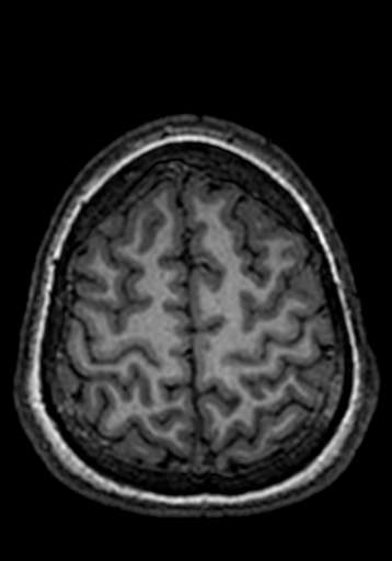 File:Cerebral arteriovenous malformation at posterior body of corpus callosum (Radiopaedia 74111-84925 Axial T1 39).jpg