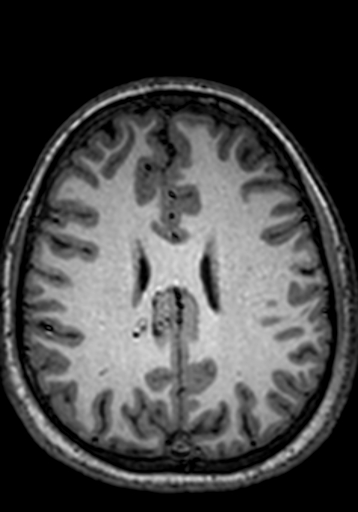 Cerebral arteriovenous malformation at posterior body of corpus callosum (Radiopaedia 74111-84925 Axial T1 97).jpg