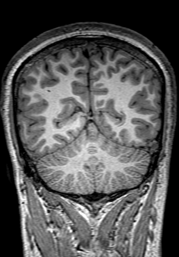Cerebral arteriovenous malformation at posterior body of corpus callosum (Radiopaedia 74111-84925 Coronal T1 260).jpg