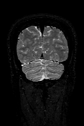 Cerebral arteriovenous malformation at posterior body of corpus callosum (Radiopaedia 74111-84925 Coronal T2 157).jpg