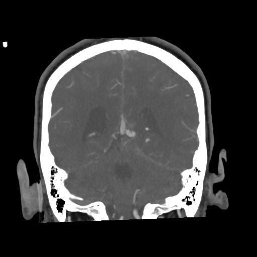 Cerebral arteriovenous malformation with lobar hemorrhage (Radiopaedia 35598-57216 C 64).jpg