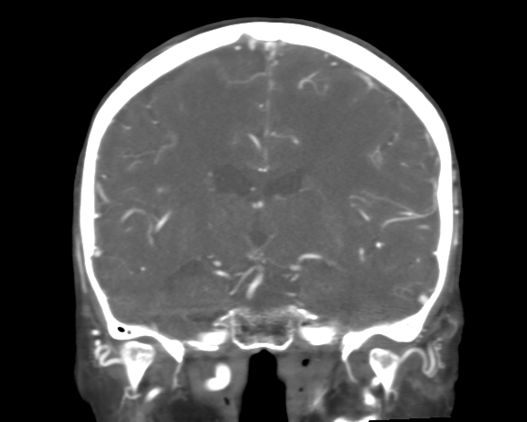 Cerebral arteriovenous malformation with lobar hemorrhage (Radiopaedia 44725-48511 A 31).png