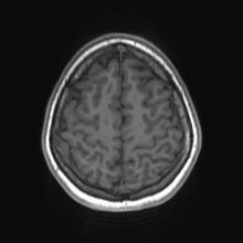 File:Cerebral cavernous venous malformation (Radiopaedia 70008-80021 Axial T1 73).jpg