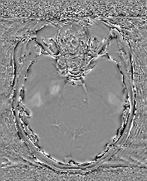 Cerebral cavernous venous malformation (Radiopaedia 70008-80021 G 25).jpg