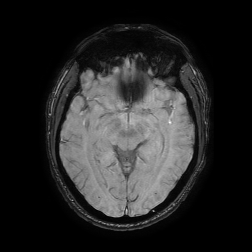 Cerebral cavernous venous malformation (Zabramski type II) (Radiopaedia 85511-101198 Axial SWI 59).jpg