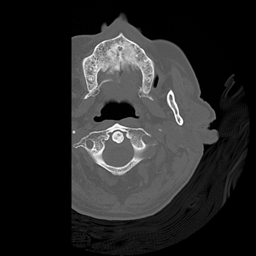Cerebral contusions, subarachnoid hemorrhage and subdural hygromas (Radiopaedia 55399-61827 Axial bone window 2).png