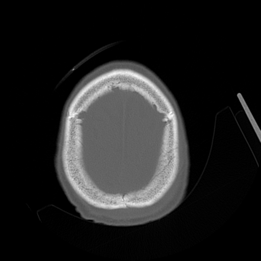 File:Cerebral contusions, subarachnoid hemorrhage and subdural hygromas (Radiopaedia 55399-61827 Axial bone window 46).png