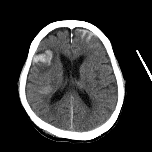 File:Cerebral contusions, subarachnoid hemorrhage and subdural hygromas (Radiopaedia 55399-61827 Axial non-contrast 20).png