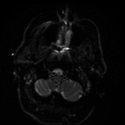 Cerebral embolic infarcts (embolic shower) (Radiopaedia 49837-55108 Axial DWI 44).jpg