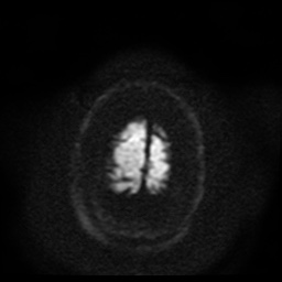 Cerebral embolic infarcts (embolic shower) (Radiopaedia 49837-55108 Axial DWI 51).jpg