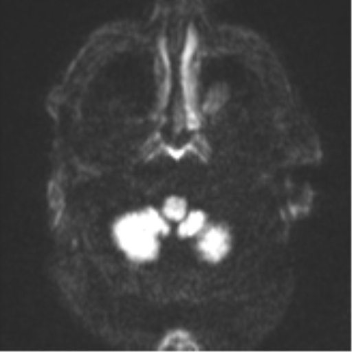 File:Cerebral embolic infarcts (embolic shower) (Radiopaedia 57395-64342 Axial DWI 40).png