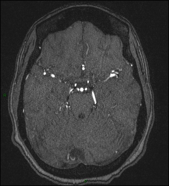 Cerebral fat embolism (Radiopaedia 35022-36525 Axial TOF 74).jpg
