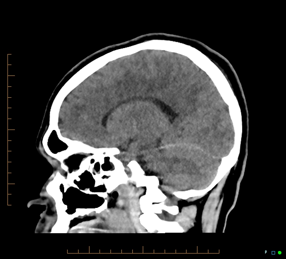 Cerebral fat embolism (Radiopaedia 85521-101220 B 33).jpg