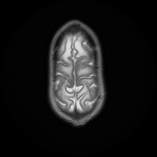 File:Cerebral manifestations of mucopolysaccharidosis type I (Radiopaedia 59171-66487 Axial T2 20).jpg