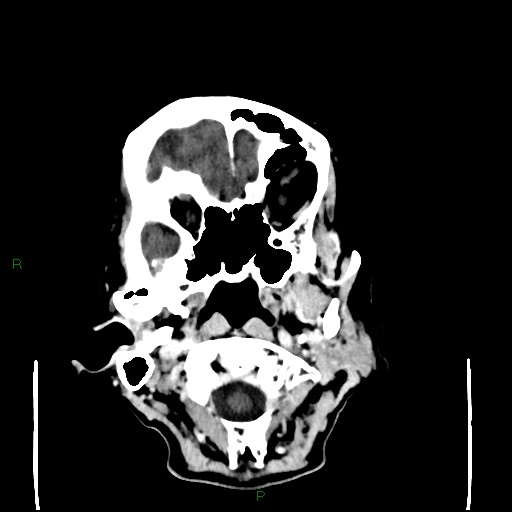 Cerebral metastases - breast primary (Radiopaedia 77653-89857 Axial C+ delayed 16).jpg