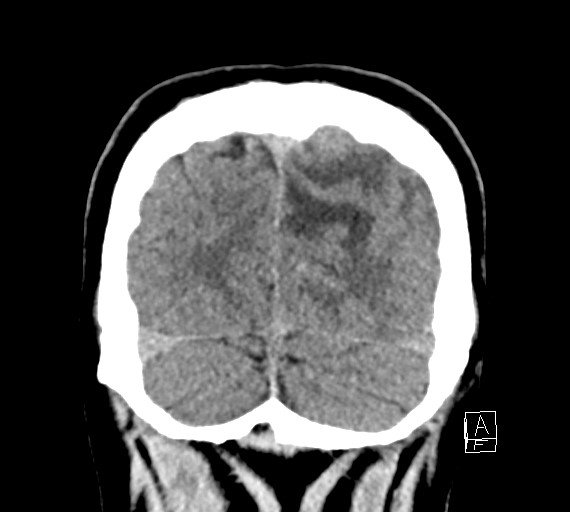 Cerebral metastases - testicular choriocarcinoma (Radiopaedia 84486-99855 Coronal C+ delayed 54).jpg