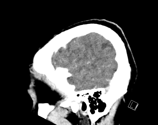Cerebral metastases - testicular choriocarcinoma (Radiopaedia 84486-99855 F 11).jpg