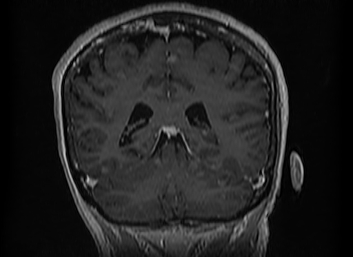 File:Cerebral metastases from lung cancer with amyloid angiopathy and cerebellopontine angle meningioma (Radiopaedia 74306-85191 Coronal T1 C+ 42).jpg