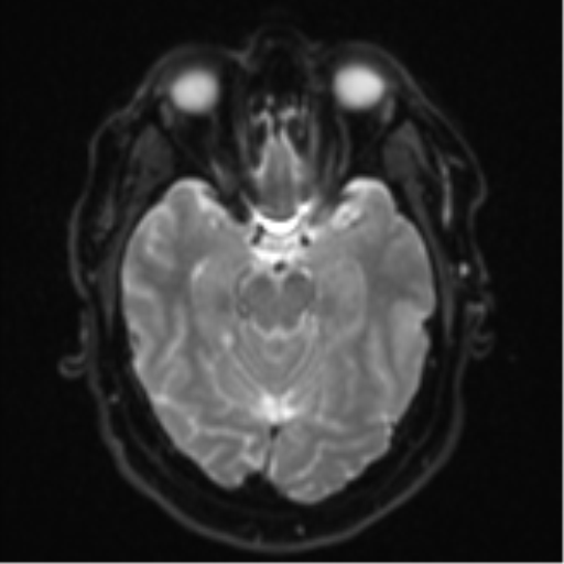Cerebral metastases mimicking multifocal glioblastoma (Radiopaedia 50843-56353 Axial DWI 10).png