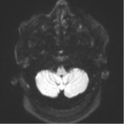 Cerebral metastases mimicking multifocal glioblastoma (Radiopaedia 50843-56353 Axial DWI 33).png