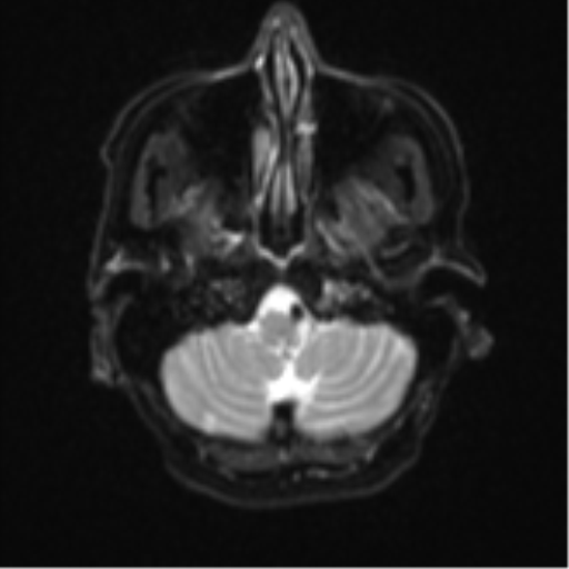 Cerebral metastasis (Radiopaedia 46744-51248 Axial DWI 4).png
