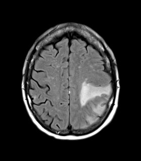 File:Cerebral metastasis (Radiopaedia 46744-51248 Axial FLAIR 21).png