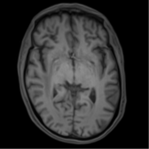 Cerebral metastasis - melanoma (Radiopaedia 54718-60954 Axial T1 25).png