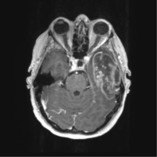 Cerebral metastasis mimicking glioblastoma (Radiopaedia 69155-78937 Axial T1 C+ 18).png