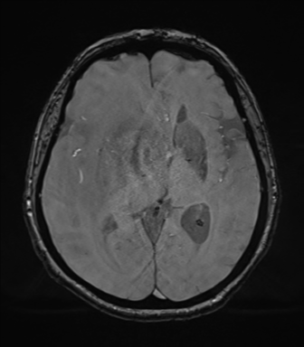 File:Cerebral metastasis to basal ganglia (Radiopaedia 81568-95413 Axial SWI magnitude 42).png
