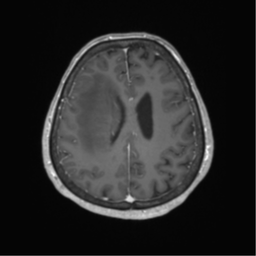 Cerebral metastasis to basal ganglia (Radiopaedia 81568-95413 Axial T1 C+ 52).png