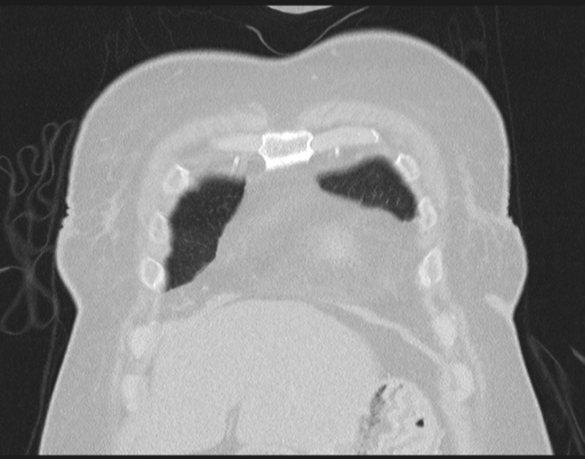 File:Cerebral metastasis to basal ganglia (Radiopaedia 81568-95414 Coronal lung window 17).png