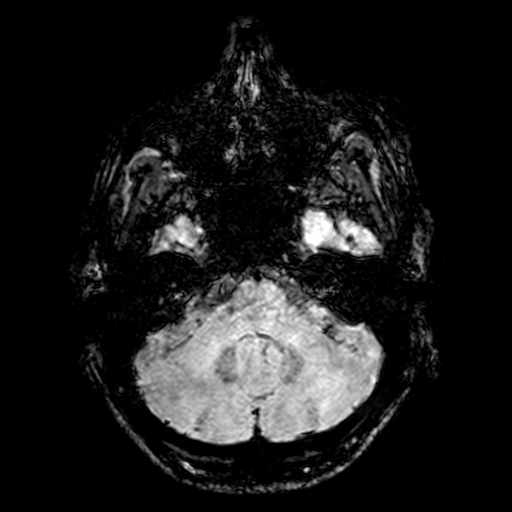 Cerebral parenchymal arteriovenous malformation (Radiopaedia 27280-27456 Axial SWI 14).jpg
