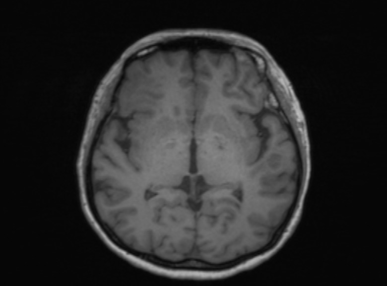 Cerebral ring enhancing lesions - cerebral metastases (Radiopaedia 44922-48817 Axial T1 233).jpg