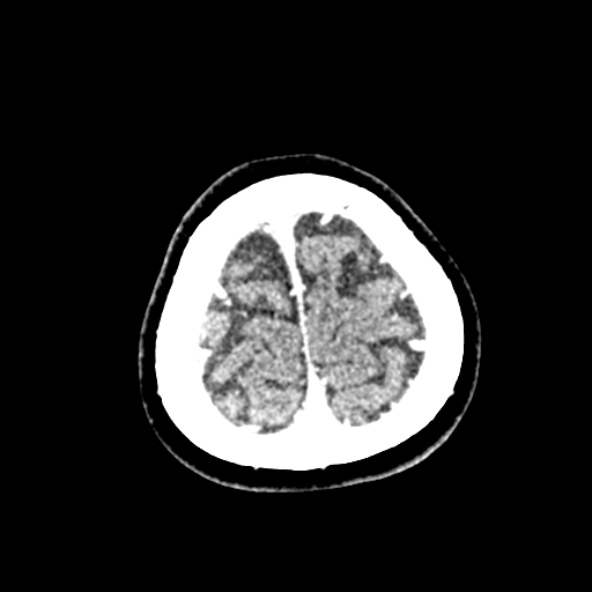 Cerebral ring enhancing lesions - cerebral metastases (Radiopaedia 44922-48818 B 261).jpg
