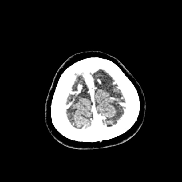 File:Cerebral ring enhancing lesions - cerebral metastases (Radiopaedia 44922-48818 B 267).jpg