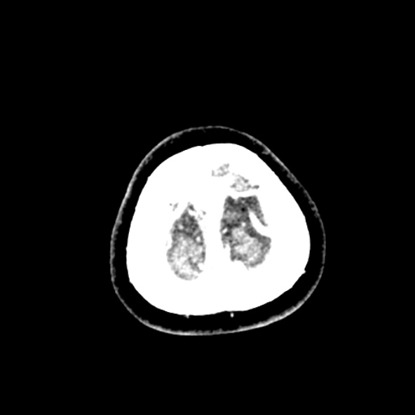Cerebral ring enhancing lesions - cerebral metastases (Radiopaedia 44922-48818 B 274).jpg