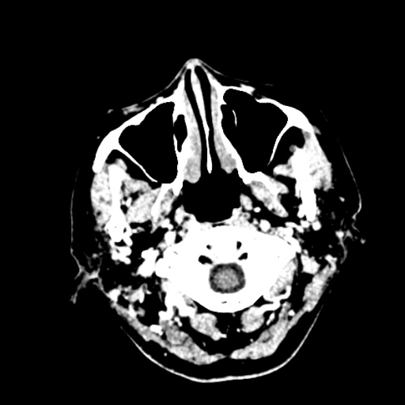 Cerebral ring enhancing lesions - cerebral metastases (Radiopaedia 44922-48818 B 9).jpg