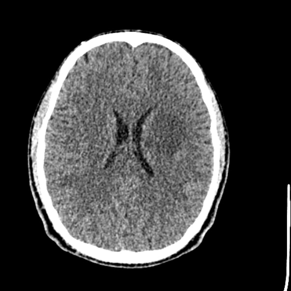 File:Cerebral toxoplasmosis (Radiopaedia 53993-60131 Axial non-contrast 49).jpg