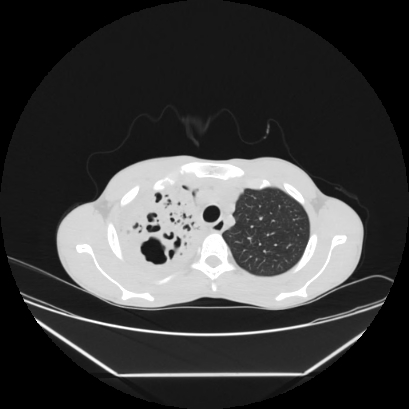Cerebral tuberculoma (Radiopaedia 80829-94318 Axial lung window 30).jpg