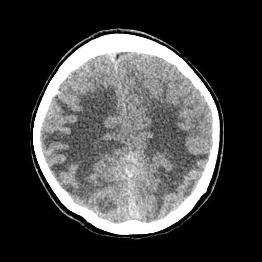 Cerebral tuberculosis with dural sinus invasion (Radiopaedia 60353-68018 Axial non-contrast 44).jpg