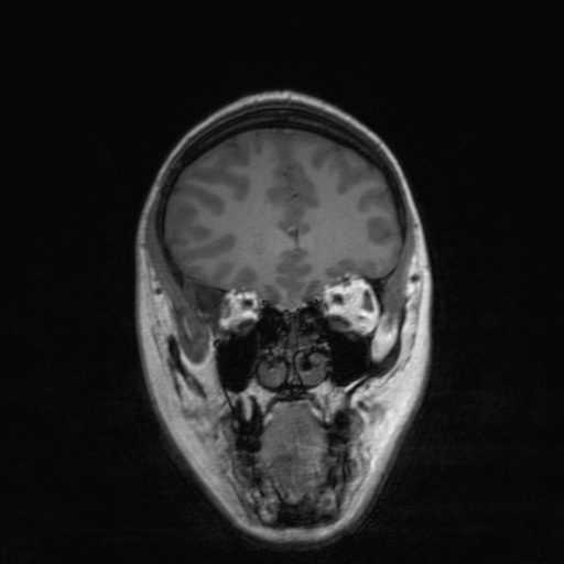 Cerebral tuberculosis with dural sinus invasion (Radiopaedia 60353-68090 Coronal T1 53).jpg