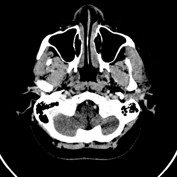 File:Cerebral venous hemorrhagic infarct from venous sinus thrombosis (Radiopaedia 55433-61883 Axial C+ delayed 133).jpg