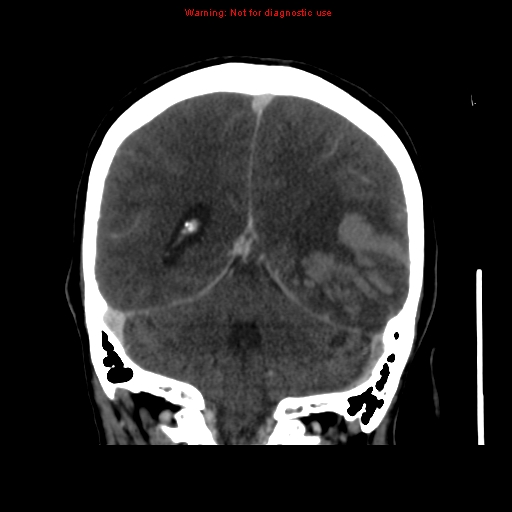 Cerebral venous infarction (Radiopaedia 12404-20735 B 56).jpg