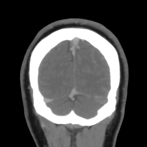 File:Cerebral venous infarction due to transverse sinus thrombosis (Radiopaedia 34688-36120 Coronal 53).png
