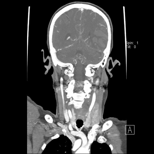 Cerebral venous infarction with hemorrhage (Radiopaedia 65343-74396 B 195).jpg